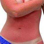 Sonnenbrand